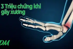 3 Triệu Chứng Chắc Chắn Gãy Xương: Nhận Biết Và Xử Lý Đúng Cách