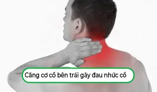 Căng cơ cổ bên trái là gì