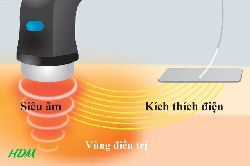 Cơ chế hoạt động của siêu âm trị liệu