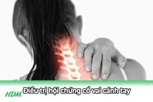 Hội chứng cổ vai cánh tay nguy hiểm không ngờ và giải pháp