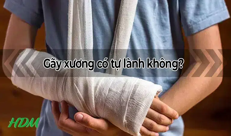 Gãy xương có tự lành không