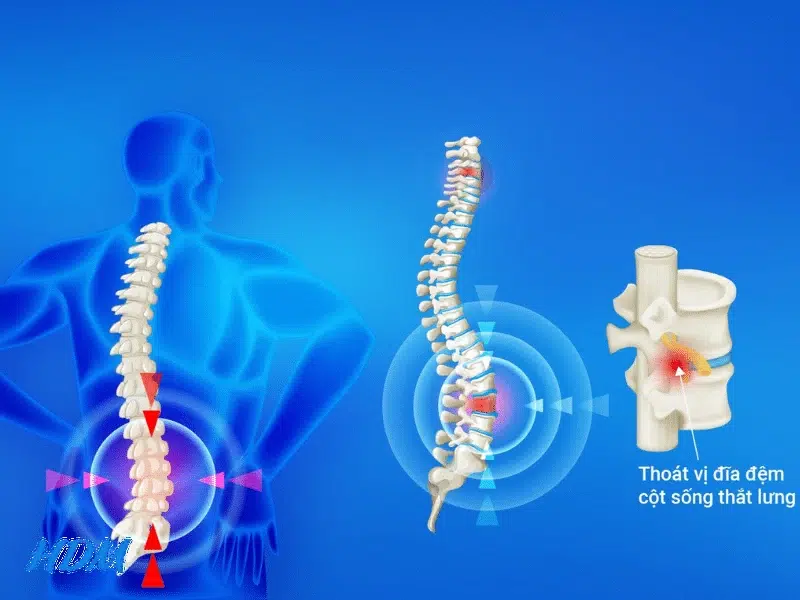 Thoát vị đĩa đệm