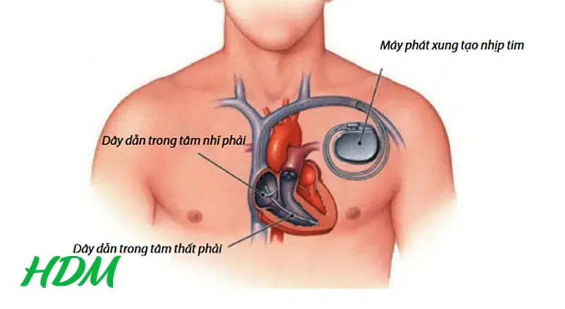 không dùng trên người có máy tạo nhịp tim