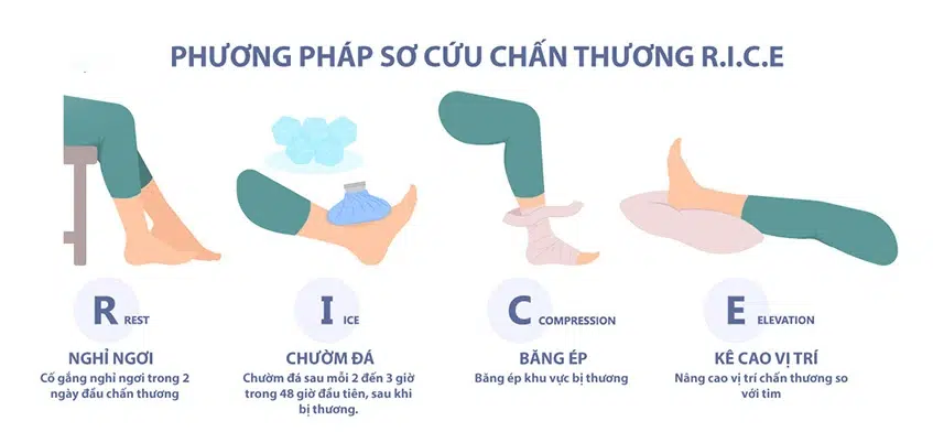 phương pháp RICE trị căng cơ nhanh