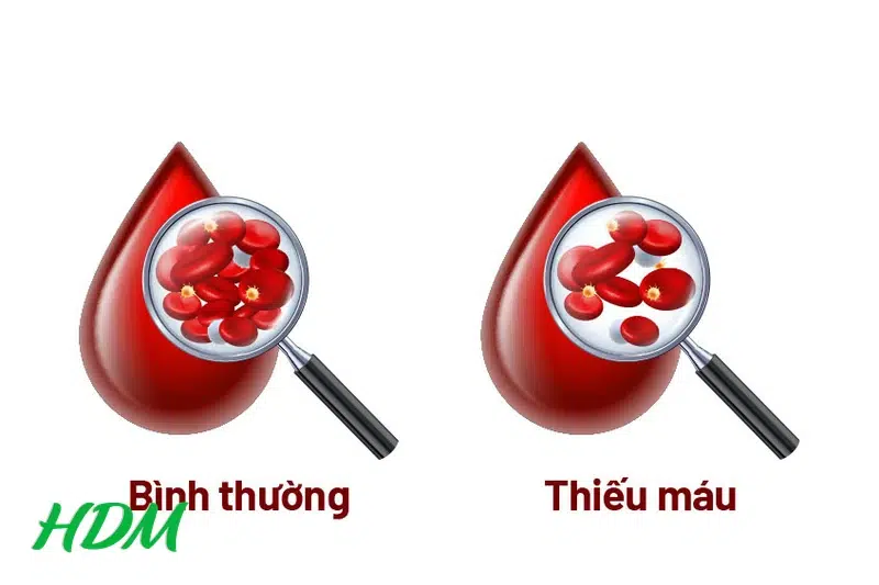 Thiếu máu nghiêm trọng không thể truyền máu