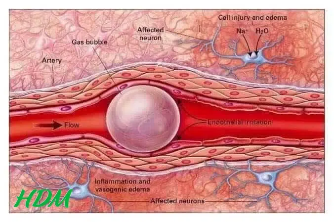 kích thước các bong bóng khí trong cơ thể sẽ giảm đi