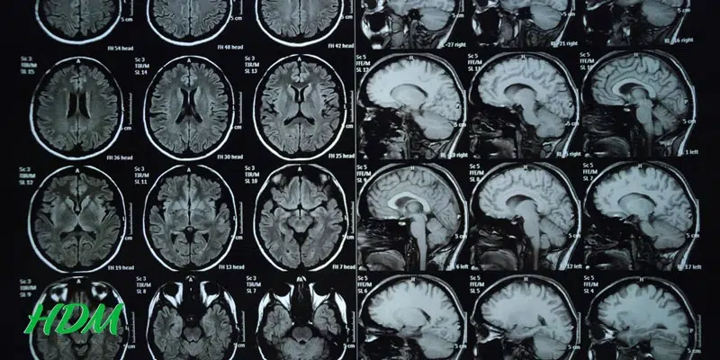 chẩn đoán hình ảnh MRI