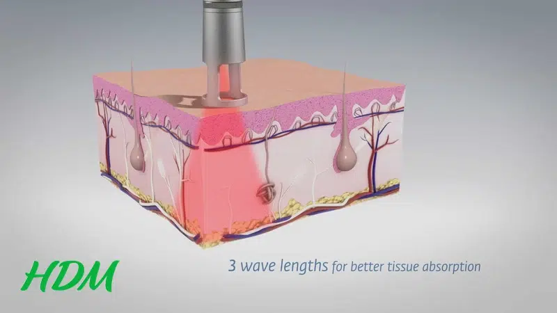 công nghệ laser trong vật lý trị liệu
