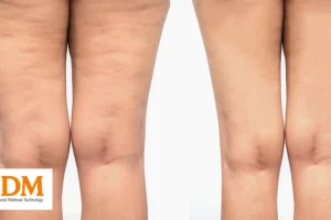 10 Lợi ích của sóng xung kích cho Giảm Cellulite tại Spa