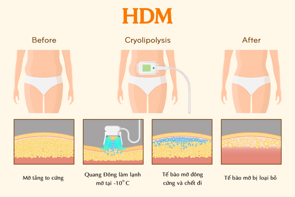Công nghệ đông hủy mỡ