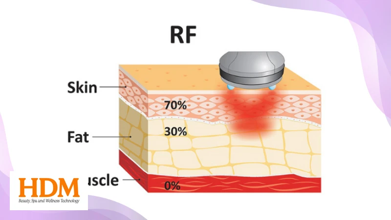 Sóng RF trong thẩm mỹ spa
