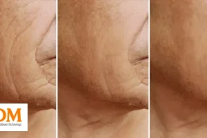 Phương pháp nào Giúp Săn Chắc Da Tốt hơn? Sóng xung kích vs RF