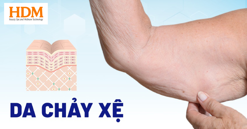 da chùng nhão chảy sệ