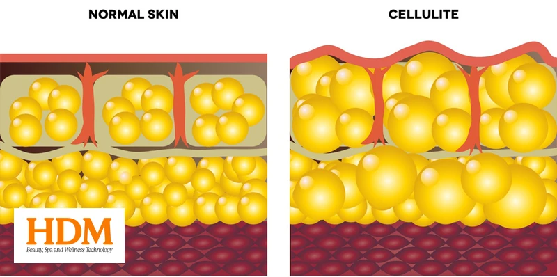 tình trạng cellulite