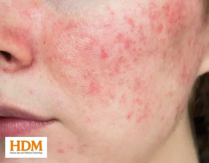 Khi nào nên chọn Cryo 7