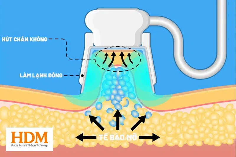 Đối tượng phù hợp với công nghệ đông hủy mỡ ZLipo